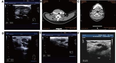 Case report: Thymoid differentiated carcinoma of thyroid: Two cases